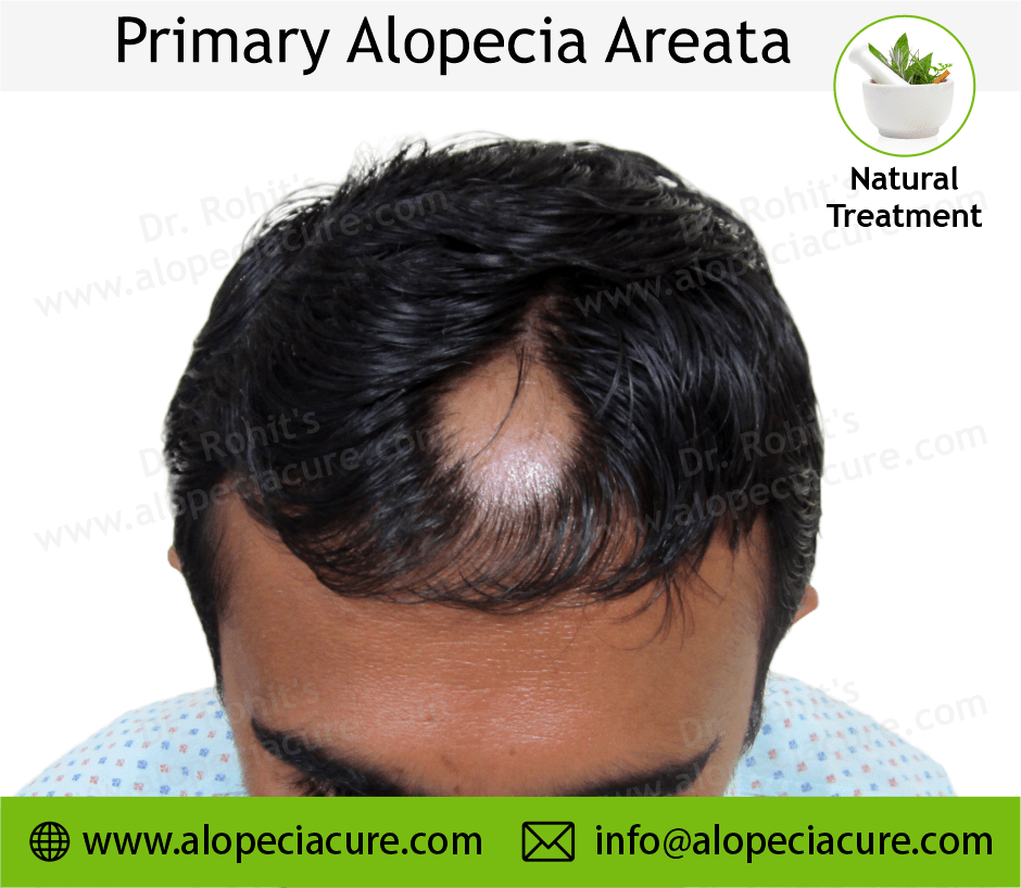 Primary Alopecia Areata