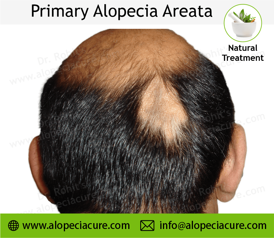 Primary Alopecia Areata