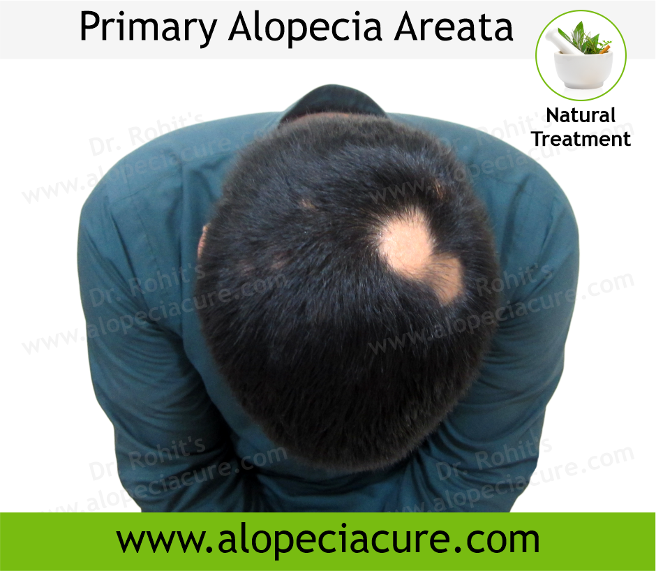 Primary Alopecia Areata