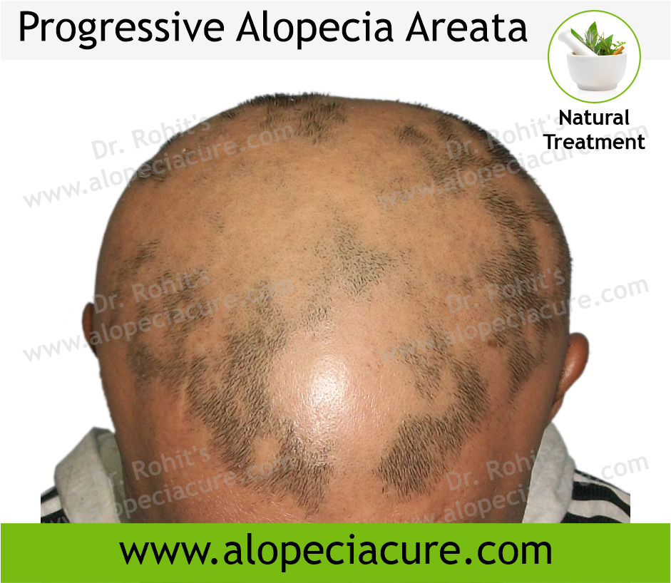 Progressive Alopecia Areata