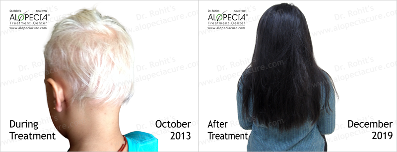 In a few patients of alopecia areata, re-growth may start with soft white hair but eventually those hairs will convert into a normal hair. Usually after about 2-3 inches of growth, hair starts getting pigmentation. In some individual, hair also become curly but it could be a part of the healing process
