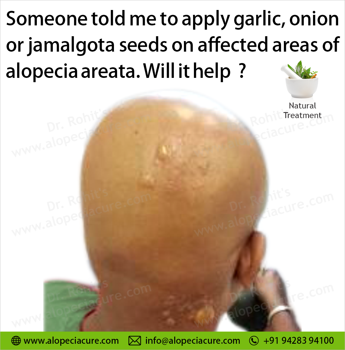 apply garlic paste or onion paste or jamalgota seeds on affected areas of alopecia areata