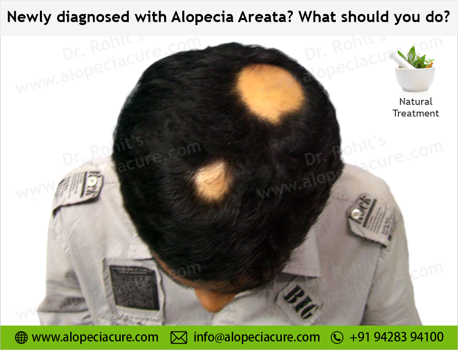 what is Alopecia areata?