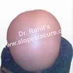 Treatment For Alopecial Areata in Natural Ways