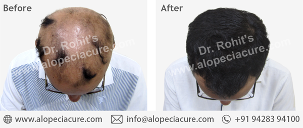 100 % Natural Treatment for Hair Loss / Alopecia