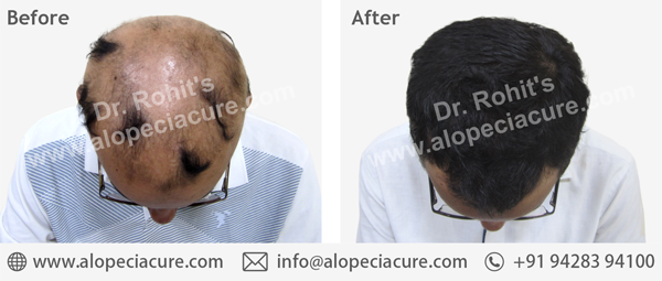 Dr. Rohit's hair loss treatment result
