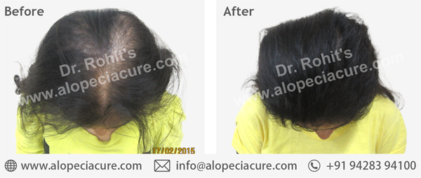 100 % Natural Treatment for Hair Loss / Alopecia 100 % Natural Treatment for Hair Loss / Alopecia