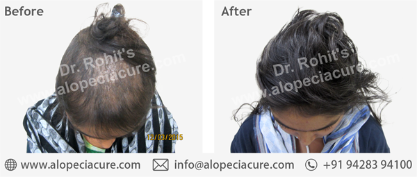 Dr. Rohit's hair loss treatment result