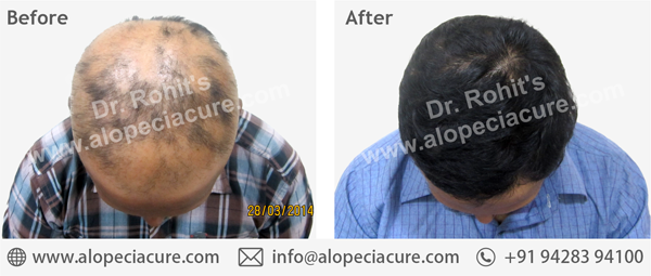 100 % Natural Treatment for Hair Loss / Alopecia 100 % Natural Treatment for Hair Loss / Alopecia