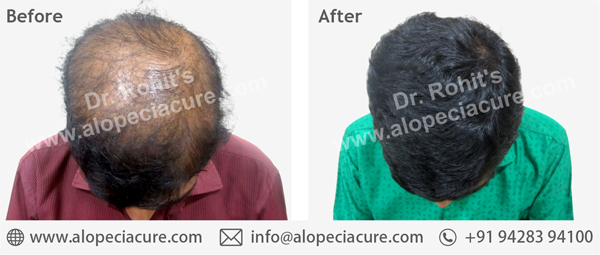 100 % Natural Treatment for Hair Loss / Alopecia 100 % Natural Treatment for Hair Loss / Alopecia