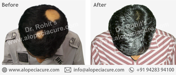 Dr. Rohit's hair loss treatment result