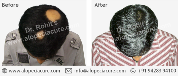 100 % Natural Treatment for Hair Loss / Alopecia 100 % Natural Treatment for Hair Loss / Alopecia