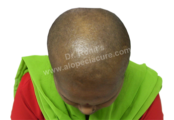 Chemotherapy Hair Loss