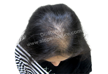 Female pattern baldness