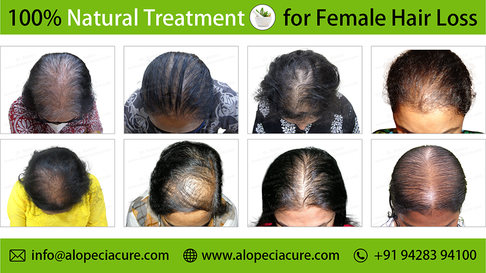 female hair loss treatment