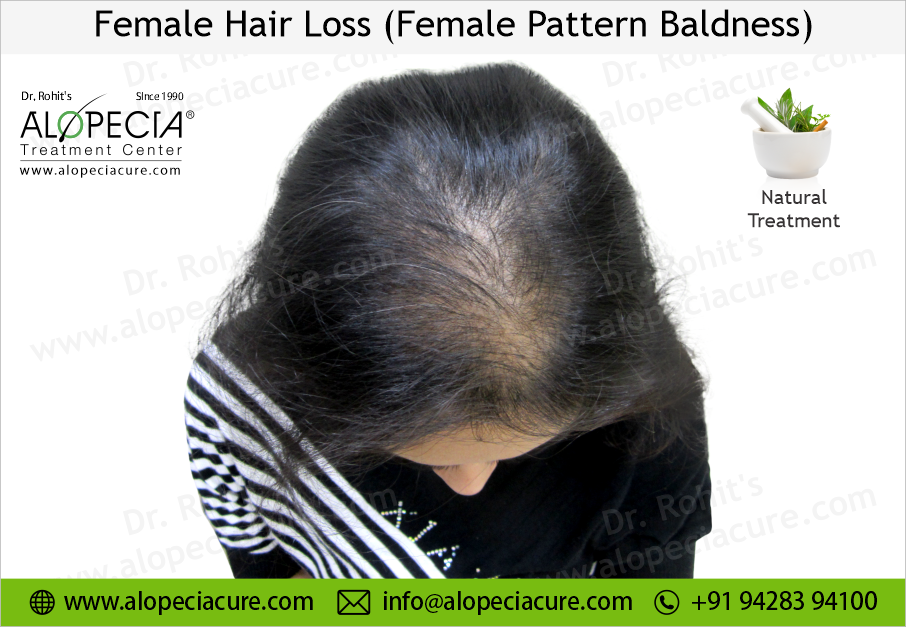 female hair loss treatment