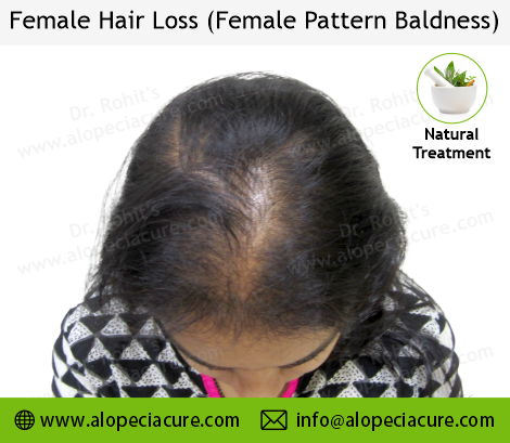 female hair loss