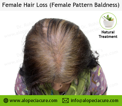 Hair loss in women  Understanding the symptoms  causes