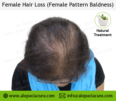 female hair loss