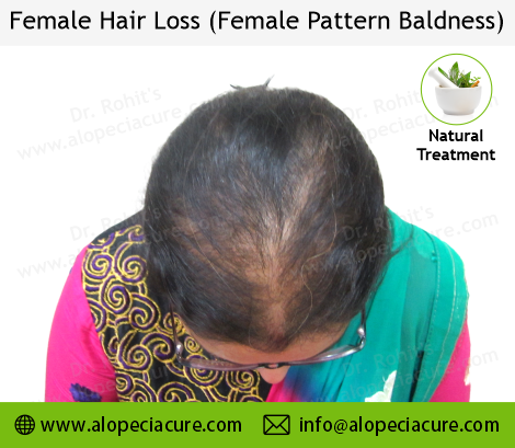 female hair loss