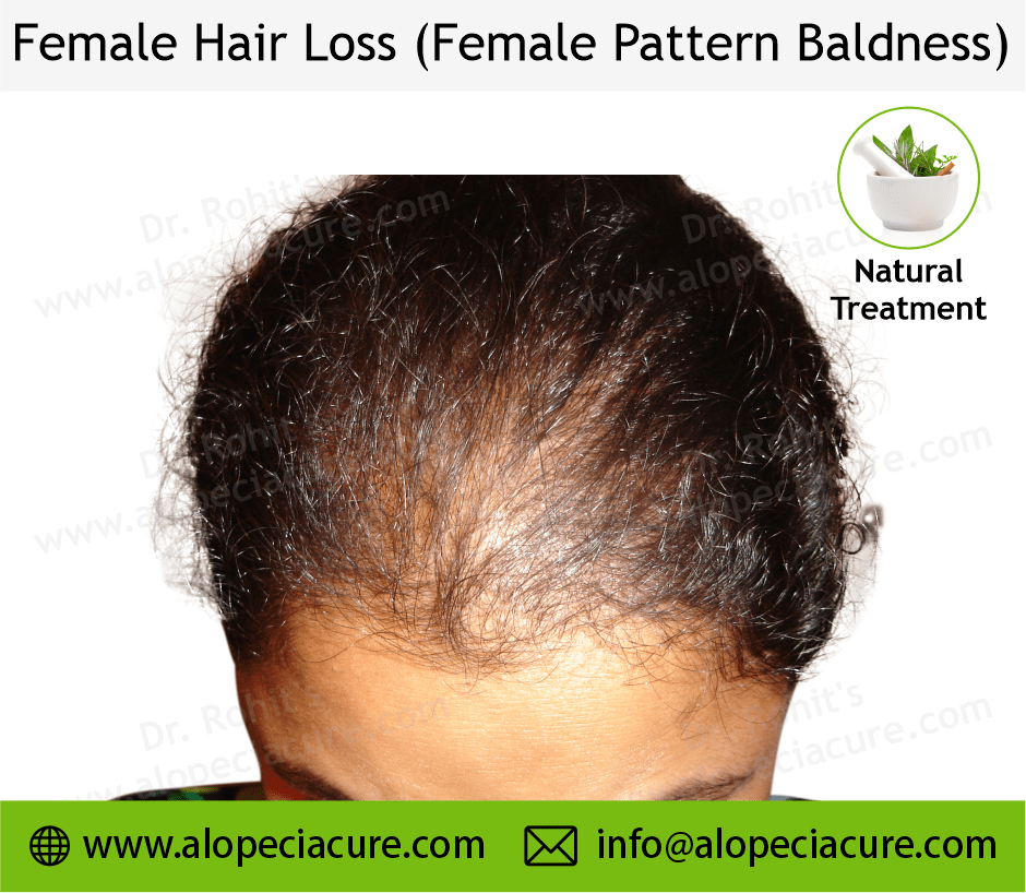 female hair loss