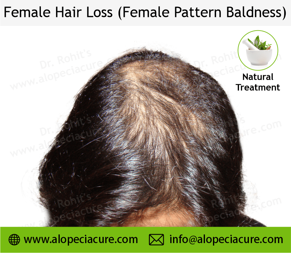 female hair loss
