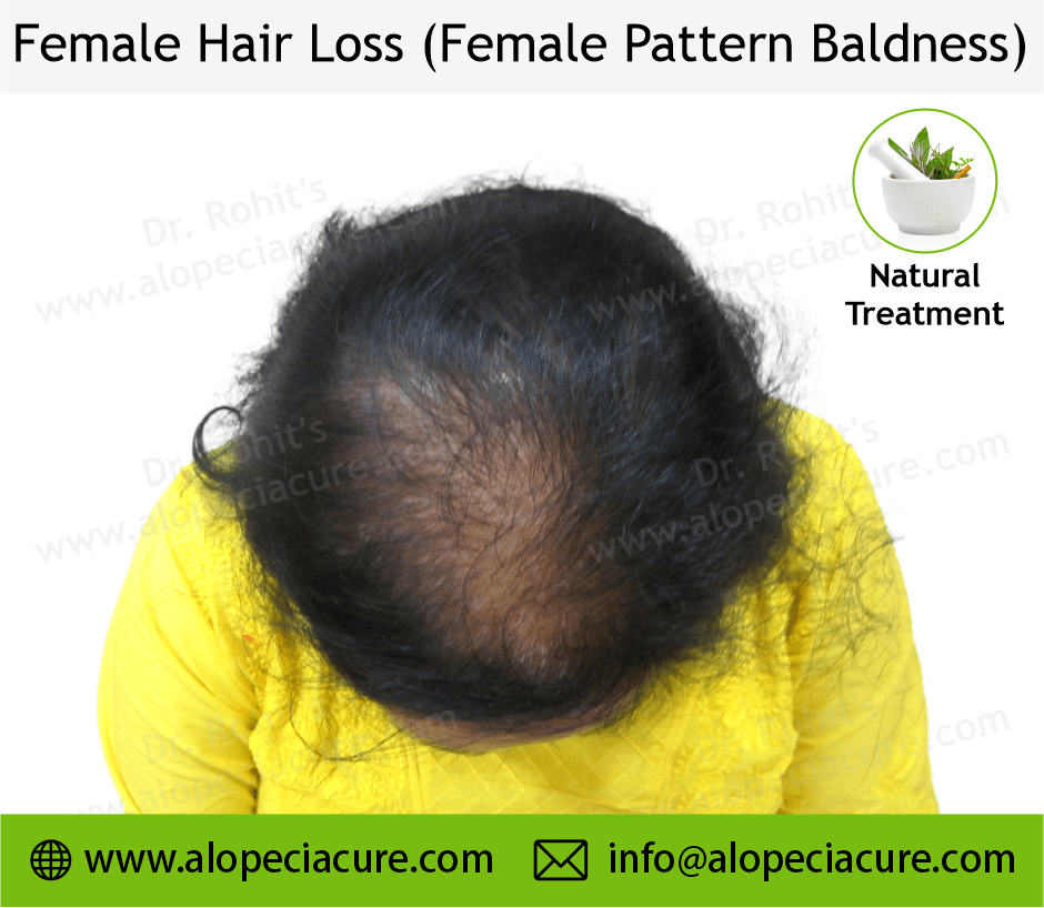 female hair loss