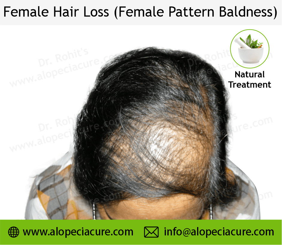 female hair loss
