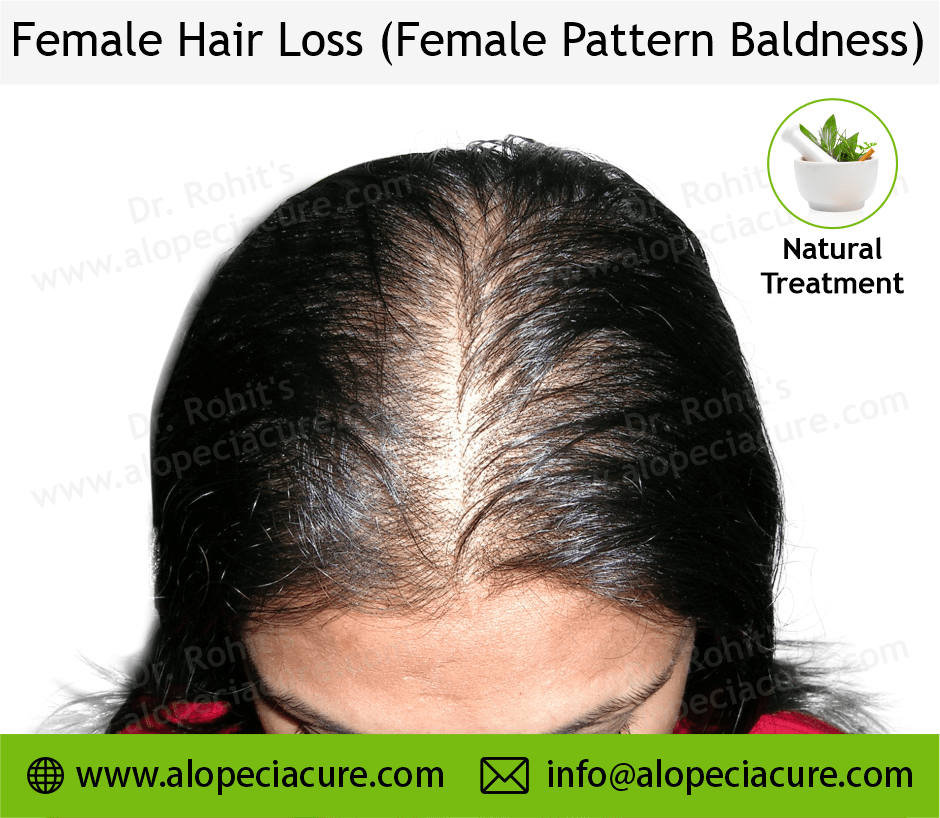 female hair loss