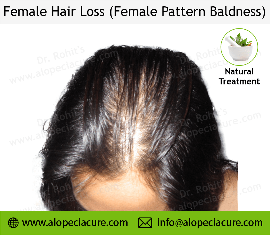 female hair loss