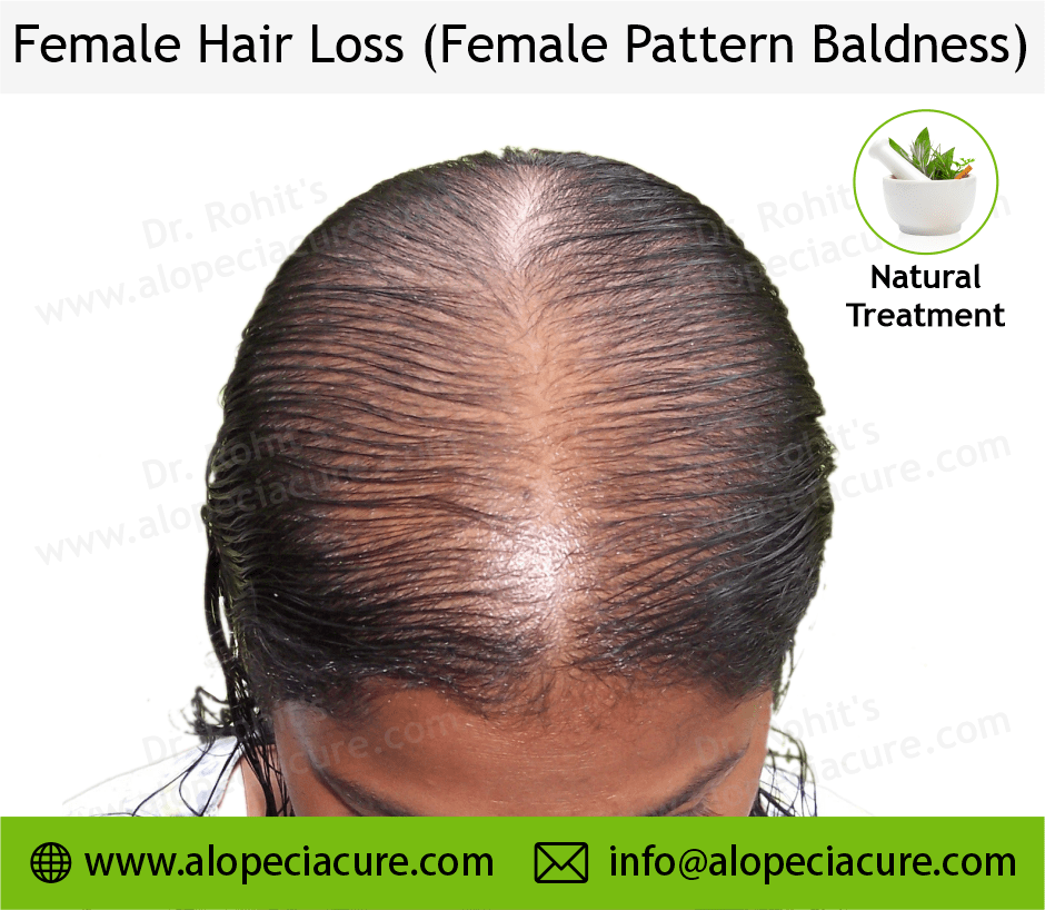 female hair loss