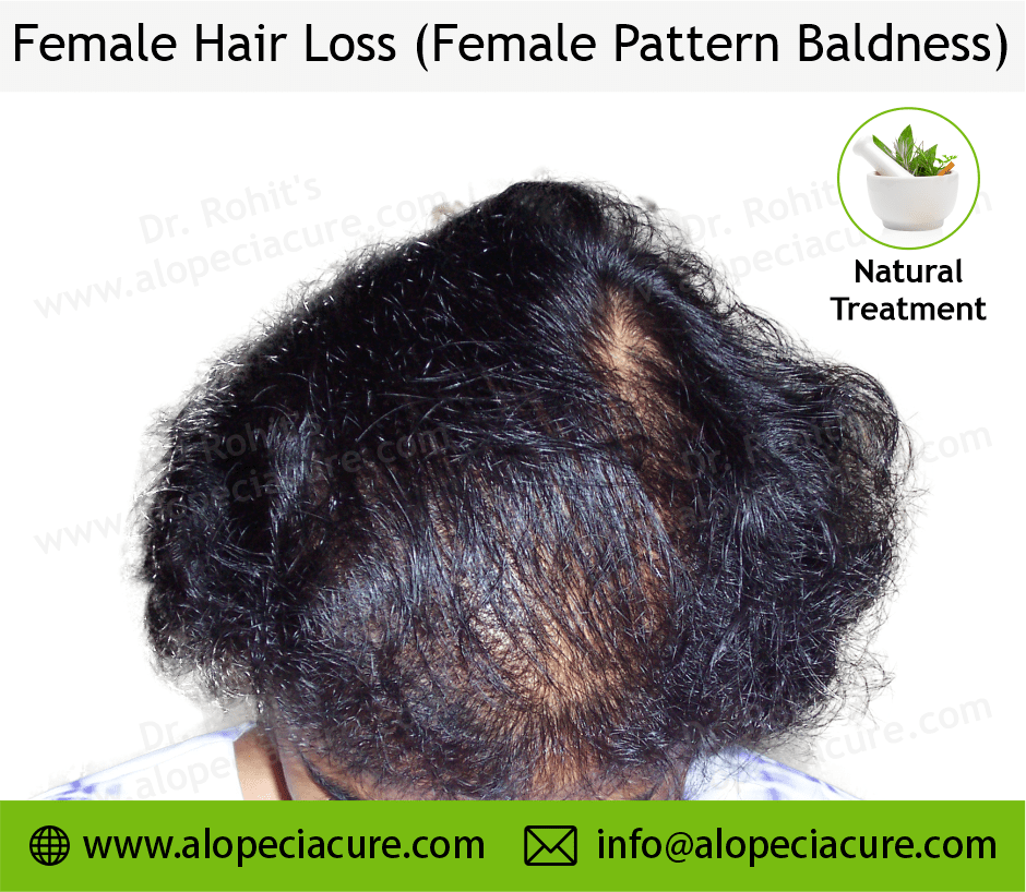 female hair loss