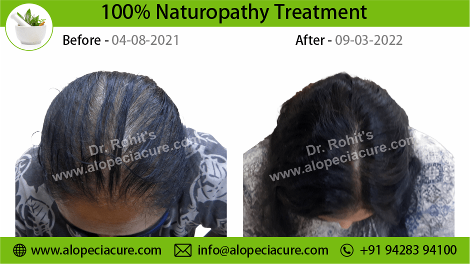 female hair loss treatment