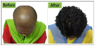 Happy Patient Of Hair Loss Treatment