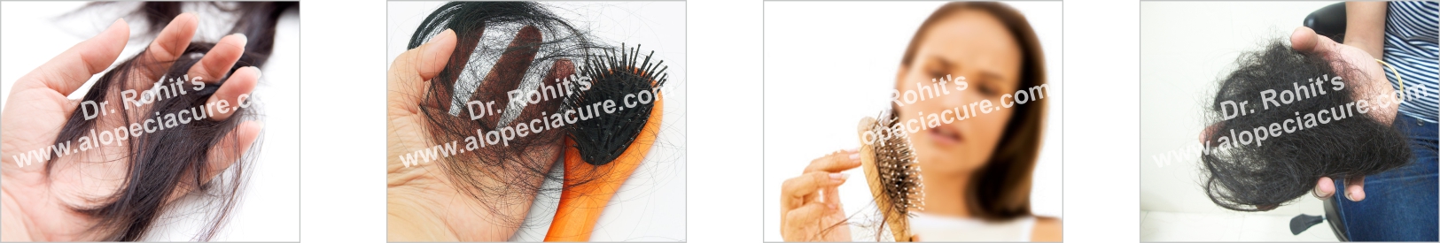 alopecia hair loss treatment - ayurvedic treatment - no side effect