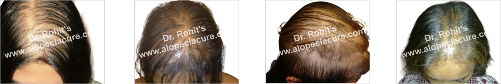 alopecia hair loss treatment - ayurvedic treatment - no side effect