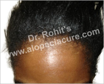 Traction Alopecia