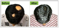 Male Pattern Baldness Treatments