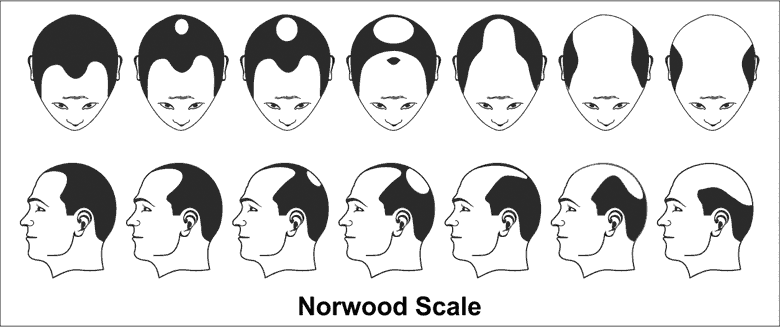Male pattern baldness (MPB)