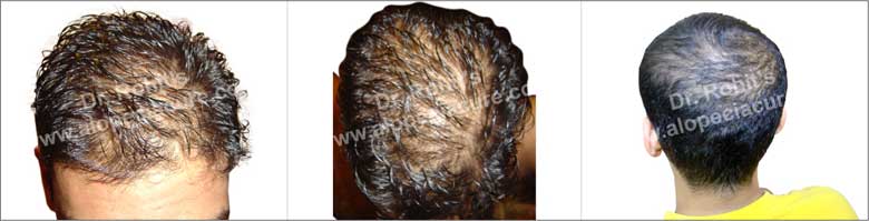 Diffuse Patterned Alopecia (DPA) & Diffuse Unpatterned Alopecia (DUPA)