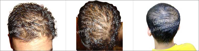 Diffuse Patterned Alopecia (DPA) & Diffuse Unpatterned Alopecia (DUPA) Diffuse Patterned Alopecia (DPA) & Diffuse Unpatterned Alopecia (DUPA)