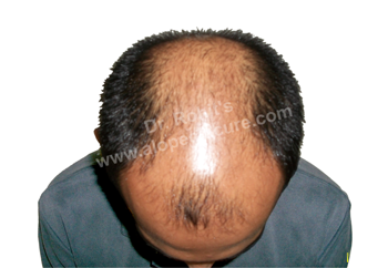 Various types of alopecia or hair loss. Try Dr Rohit's 100% Natural  Treatments.