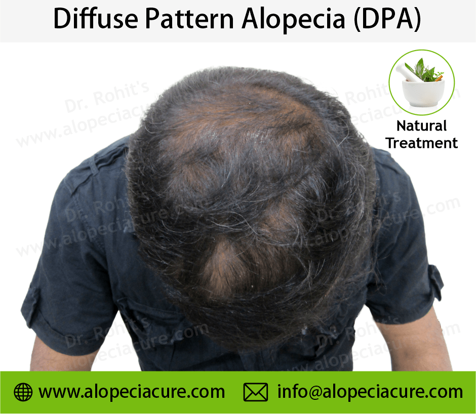 diffuse patterned alopecia