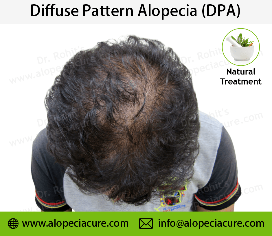 male hair loss