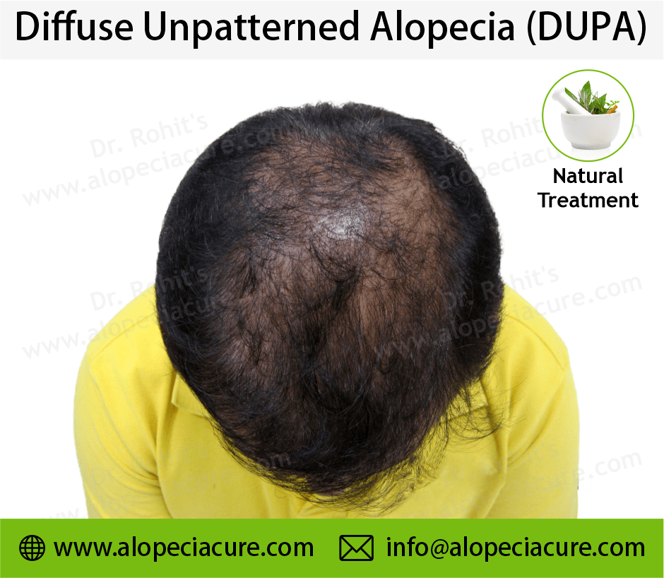 diffuse unpatterned alopecia