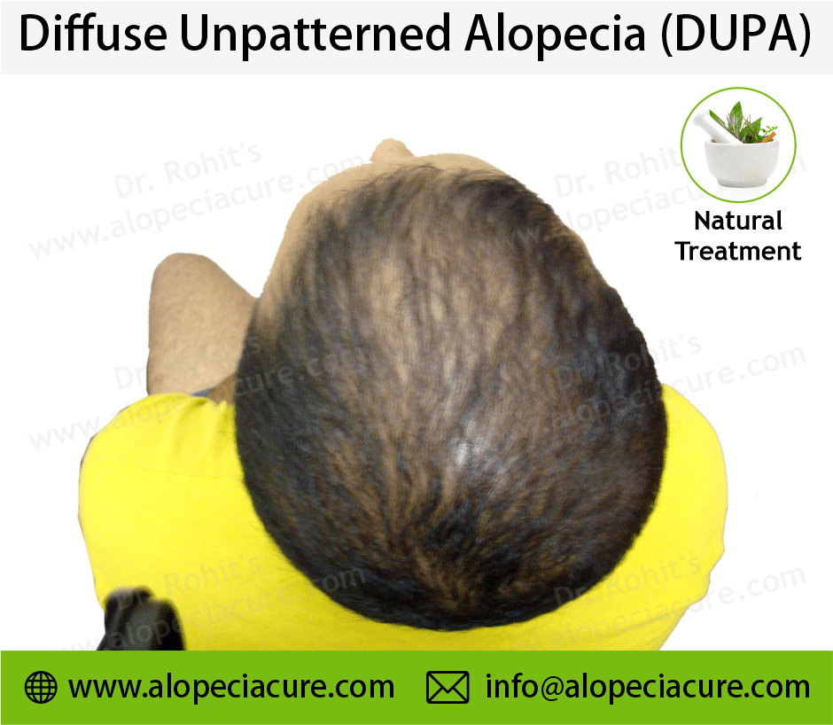 diffuse unpatterned alopecia