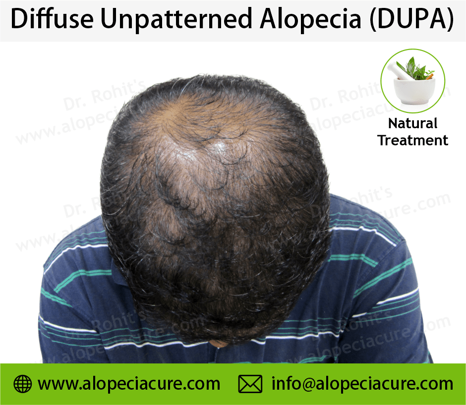 diffuse unpatterned alopecia