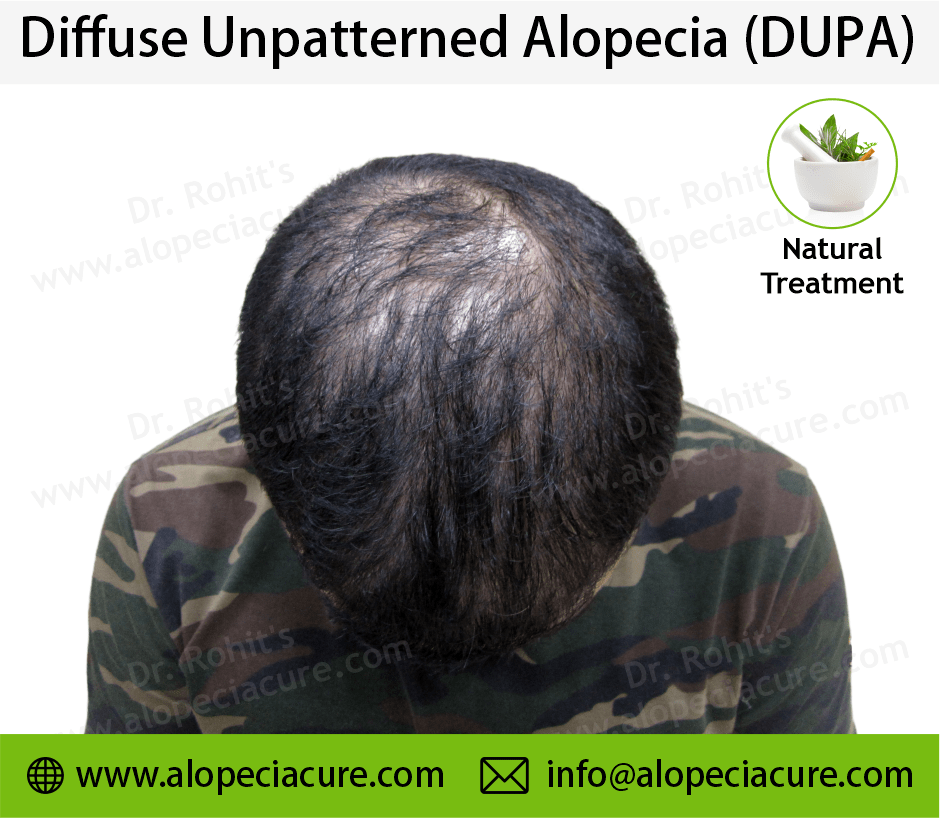 diffuse unpatterned alopecia
