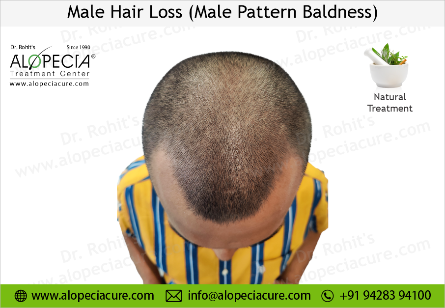 male hair loss