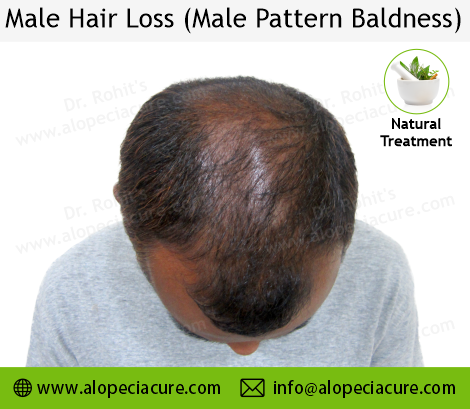 male hair loss
